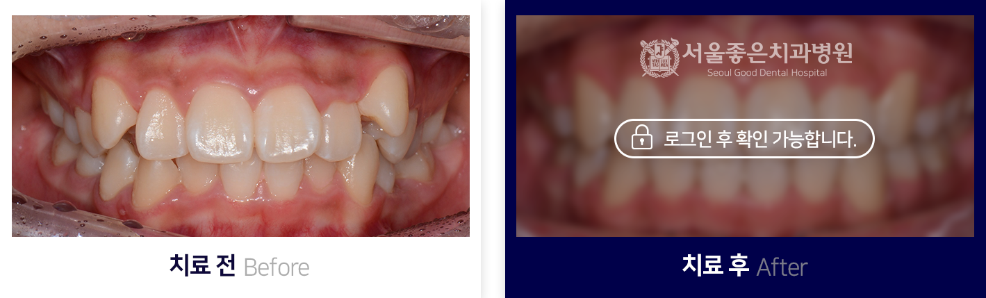 치아교정-전후사진4